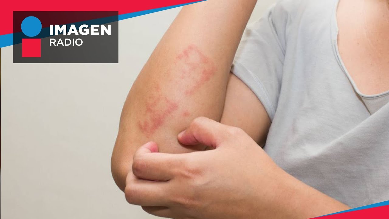 ¿Cuáles son las enfermedades más raras de la piel?