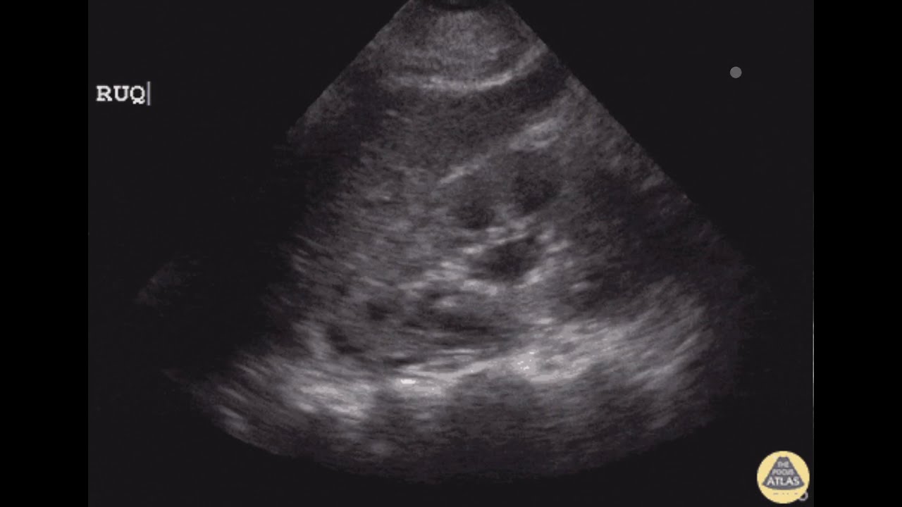 Mild Hydronephrosis from an Ureteral Stone