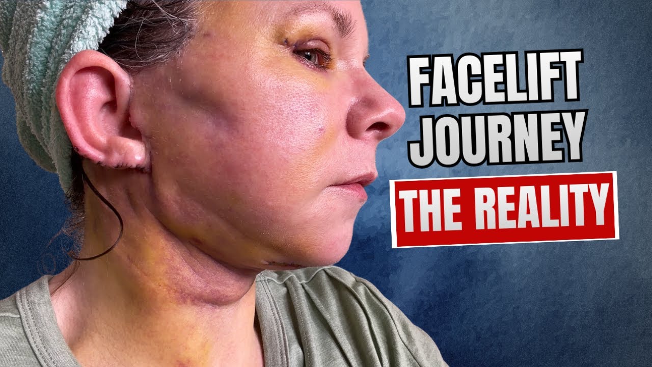 Facelift Surgery Recovery Vlog Day 9: Before & After Results