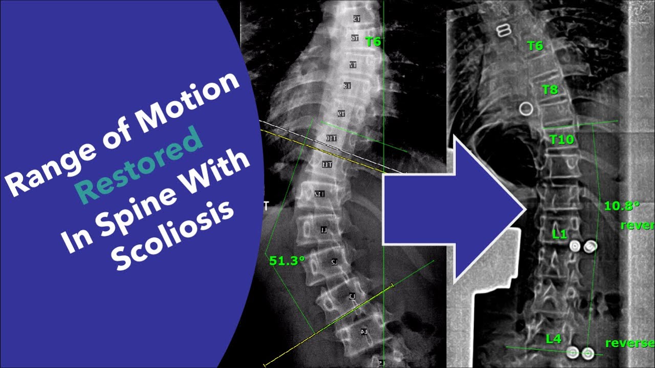 Amazing device for SCOLIOSIS restores range of motion and improves treatment without surgery