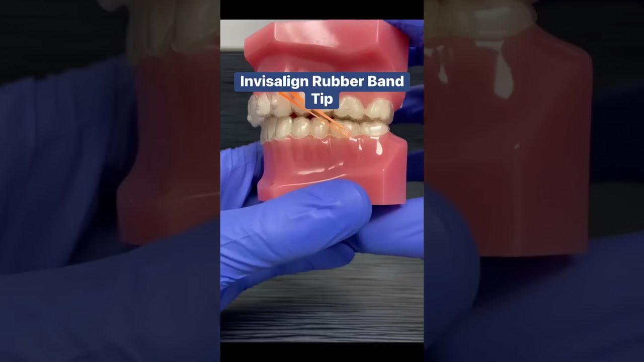 Invisalign Rubber Bands