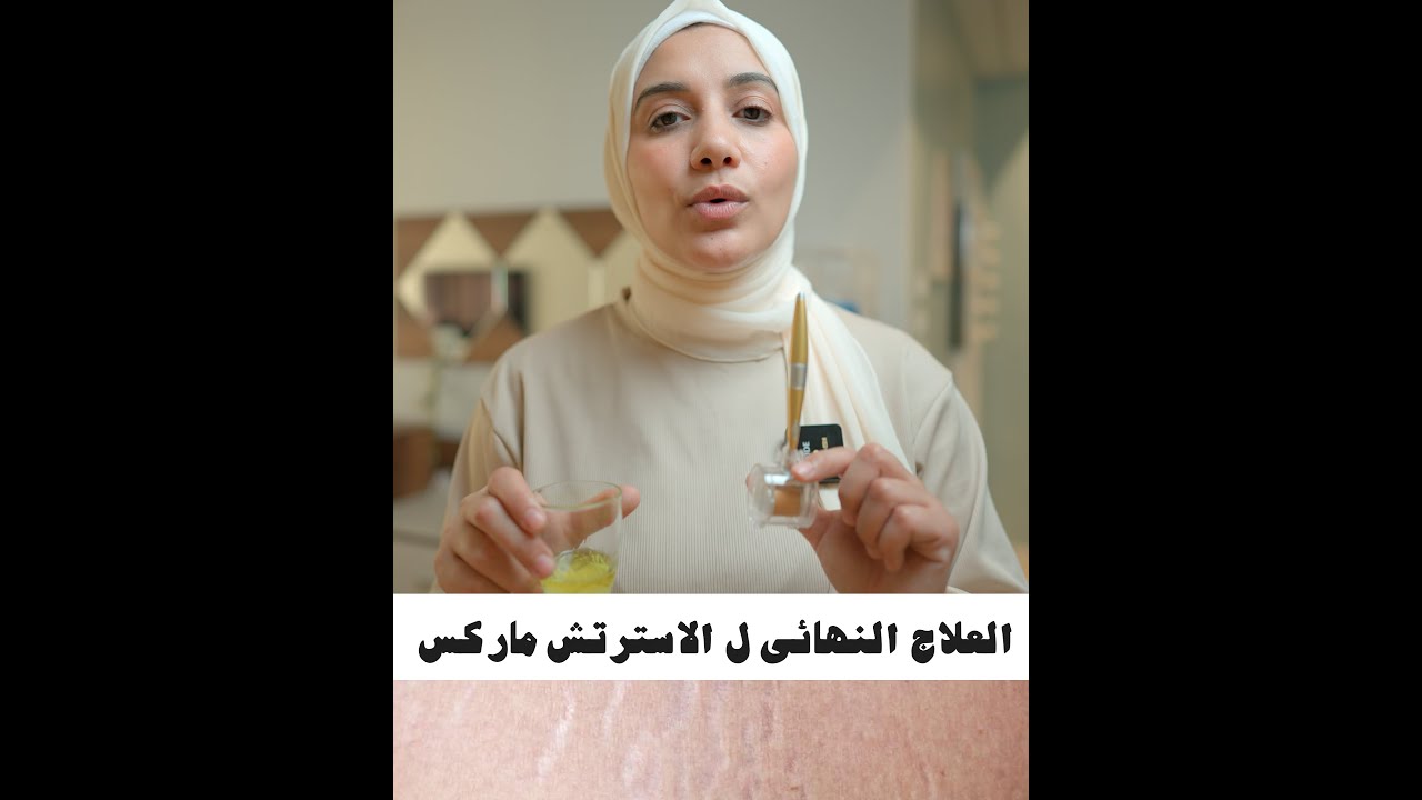 الاسترتش ماركس ؟! تجربتى معاها .. وإزاى أكتشفت الحل النهائى ليها #هنادى_خطاب