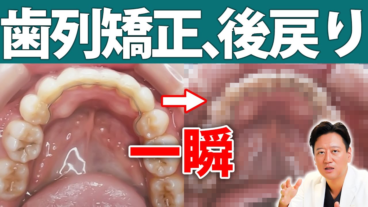 【必見】リテーナーを外したら何日で歯は動く？矯正後の後戻りについて非抜歯・抜歯・口ゴボなどどのケースが動きやすいのかも合わせて解説します【審美歯科 歯列矯正 歯並び マウスピース】