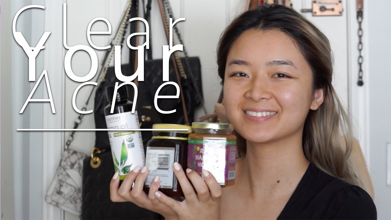 Clear Your Acne NATURALLY & CHEAPLY (2 Products + 3 Tips)