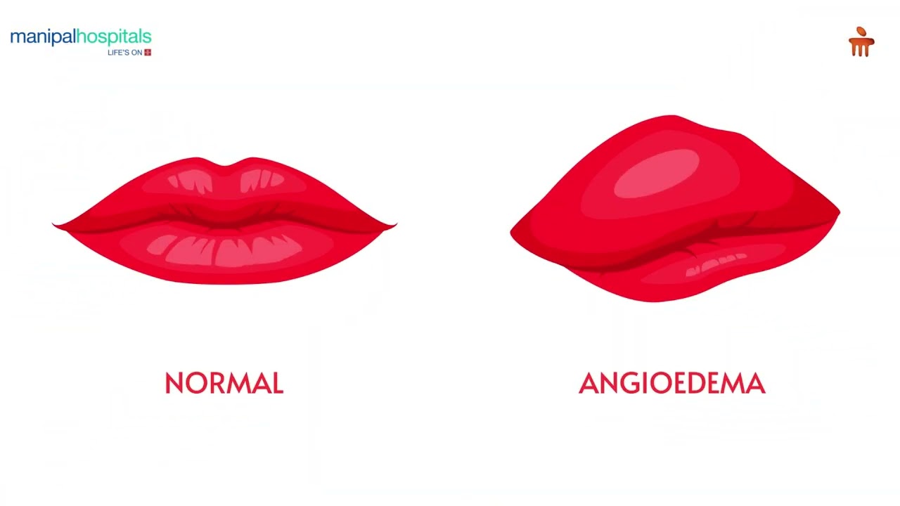 Understanding Angioedema | Dr. Ankur Kumar Jindal | Manipal Hospital Old Airport Road