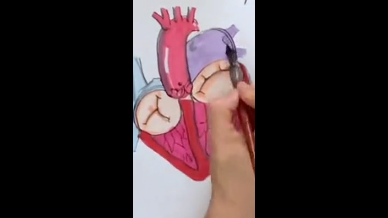 Mitral Regurgitation and KISS Repair: A Doodle Journey