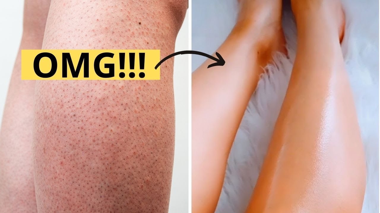 HOW TO GET RID OF STRAWBERRY LEGS IN ONE DAY! Get Rid Of Keratosis Pilaris And Dark Spots On Legs