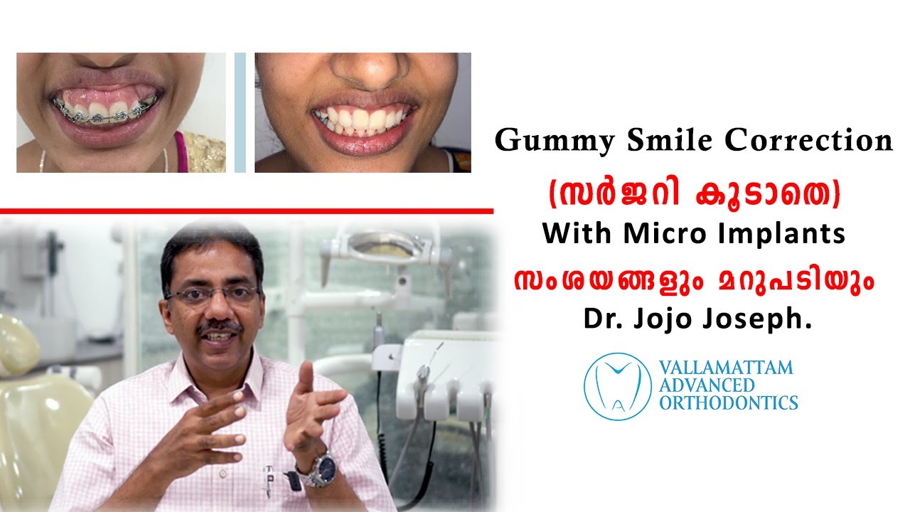 Gummy Smile Correction with Micro Implants - Questions and Answers By Dr. Jojo Joseph