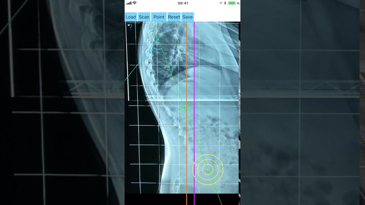 How to measure with Sagittal Balance App iOS