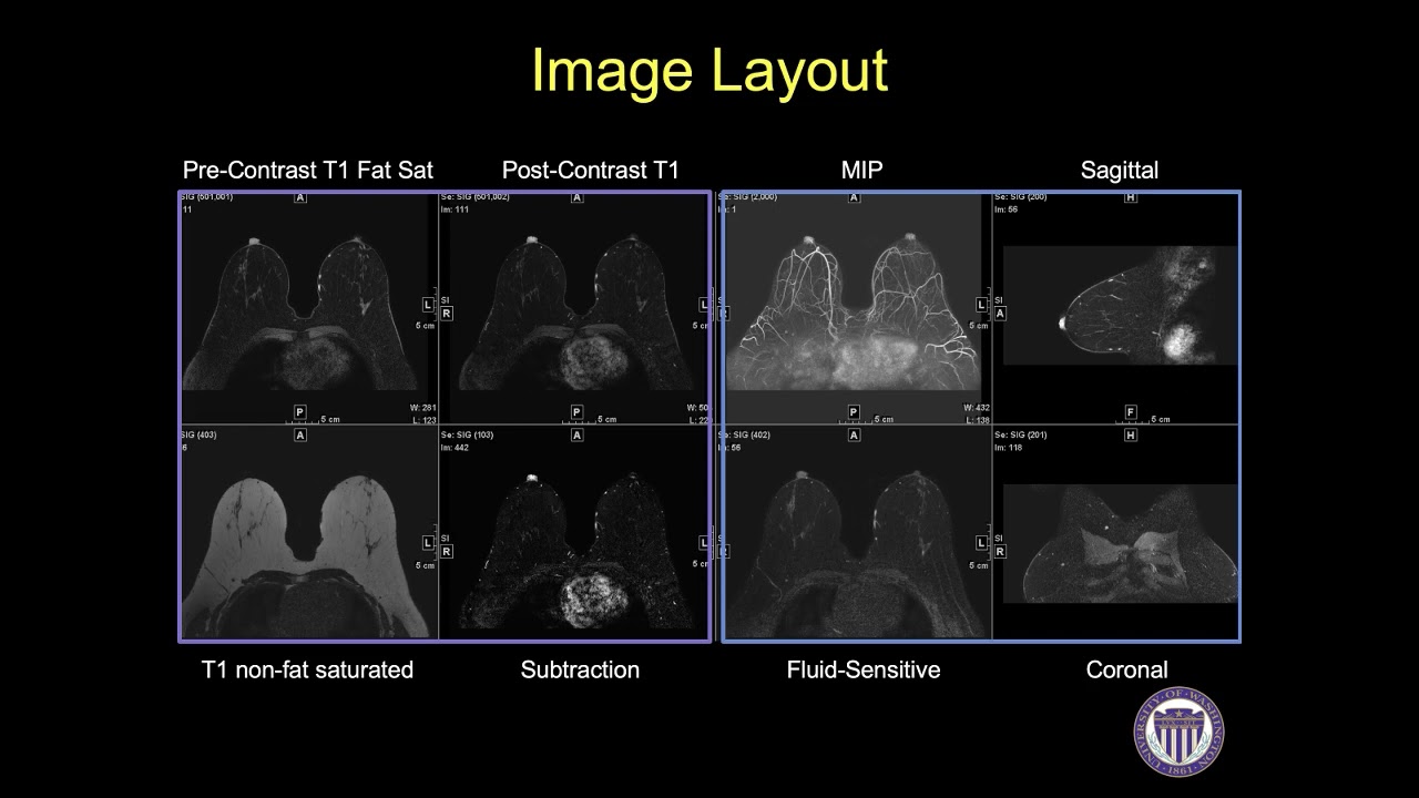 Breast MRI