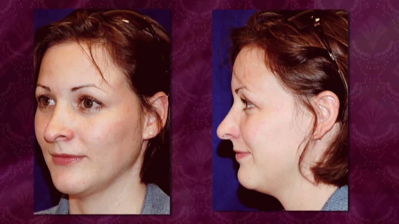 Blepharoplasty and Rhinoplasty in Augusta, Atlanta and Buckhead Georgia