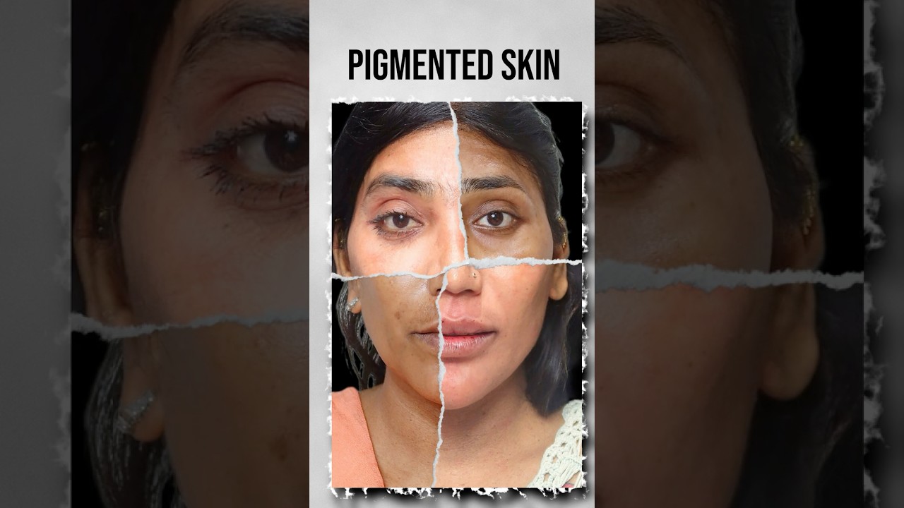 Depigmentation Treatment  | Book an Appointment +91-9289995342 | Dr Adarsh Tripathi - Sarayu Clinics