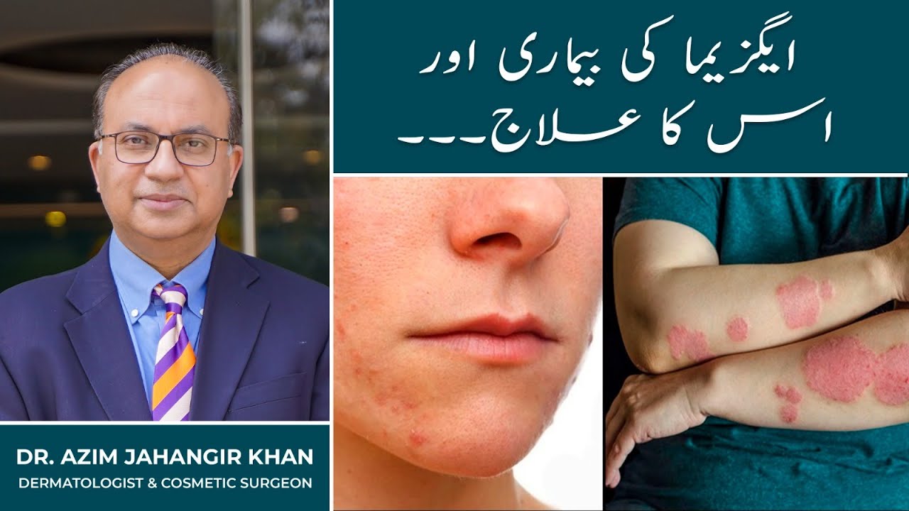 Skin Allergy | Eczema | Chambal Ka Ilaj | Best Treatment in Lahore, Islamabad, Karachi, Pakistan