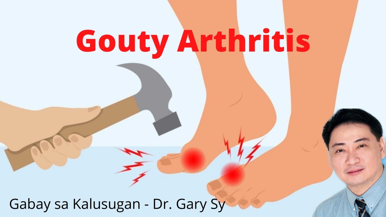 Gouty Arthritis - Dr. Gary Sy