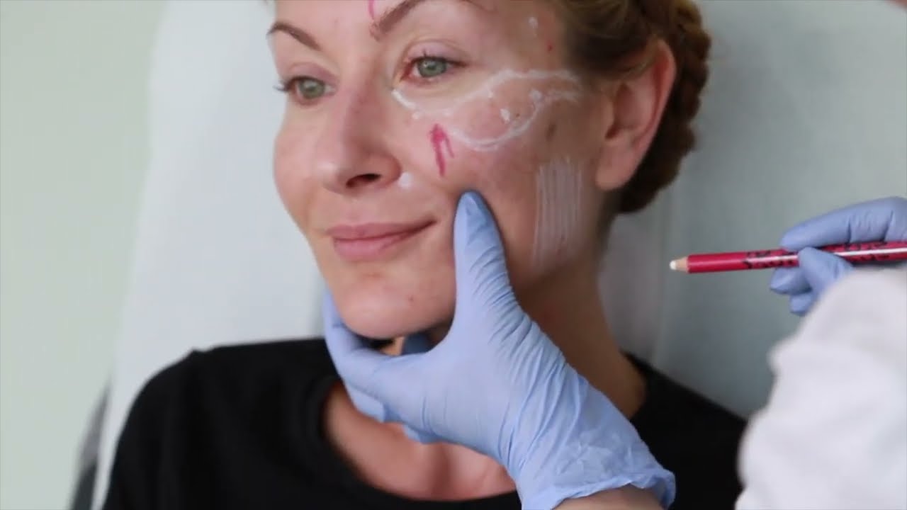 Juvederm Mid-Face Contouring: Unlock Facial Danger Zone Secrets & Wow Results! 😍