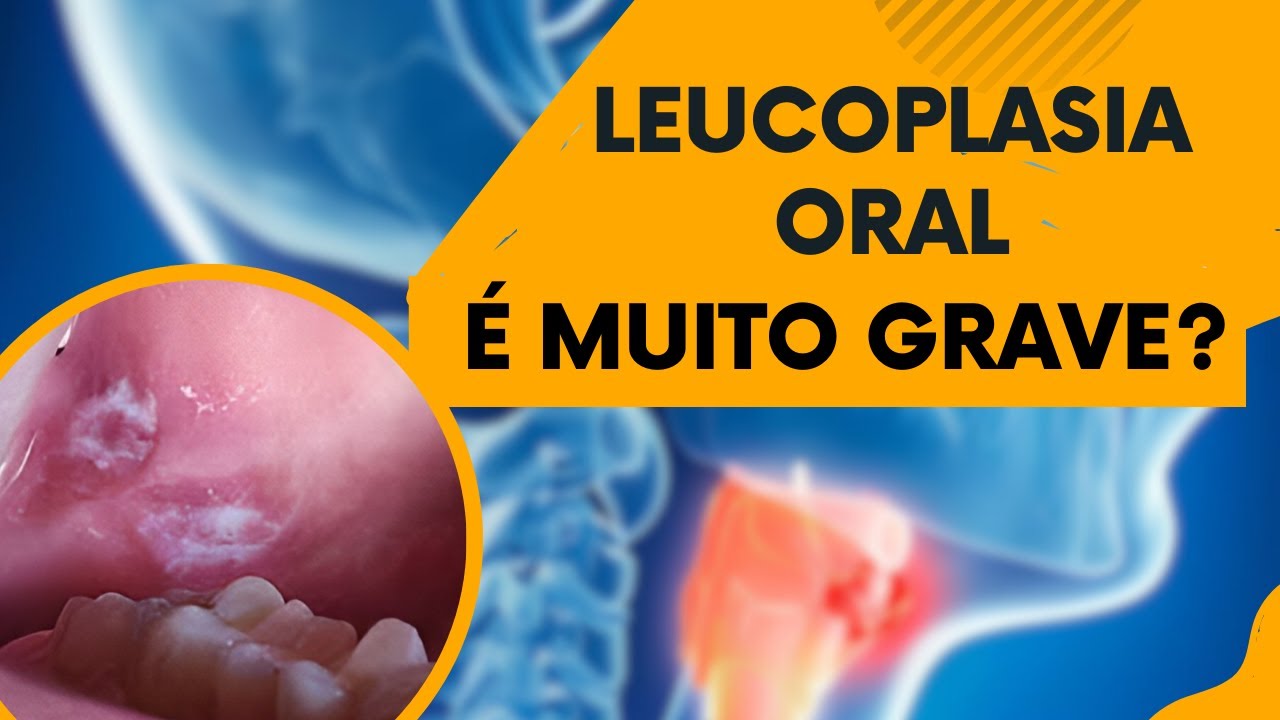 LEUCOPLASIA ORAL - MUITA ATENÇÃO PARA ESSA LESÃO NA BOCA!! | Dr. Edinei Dias.