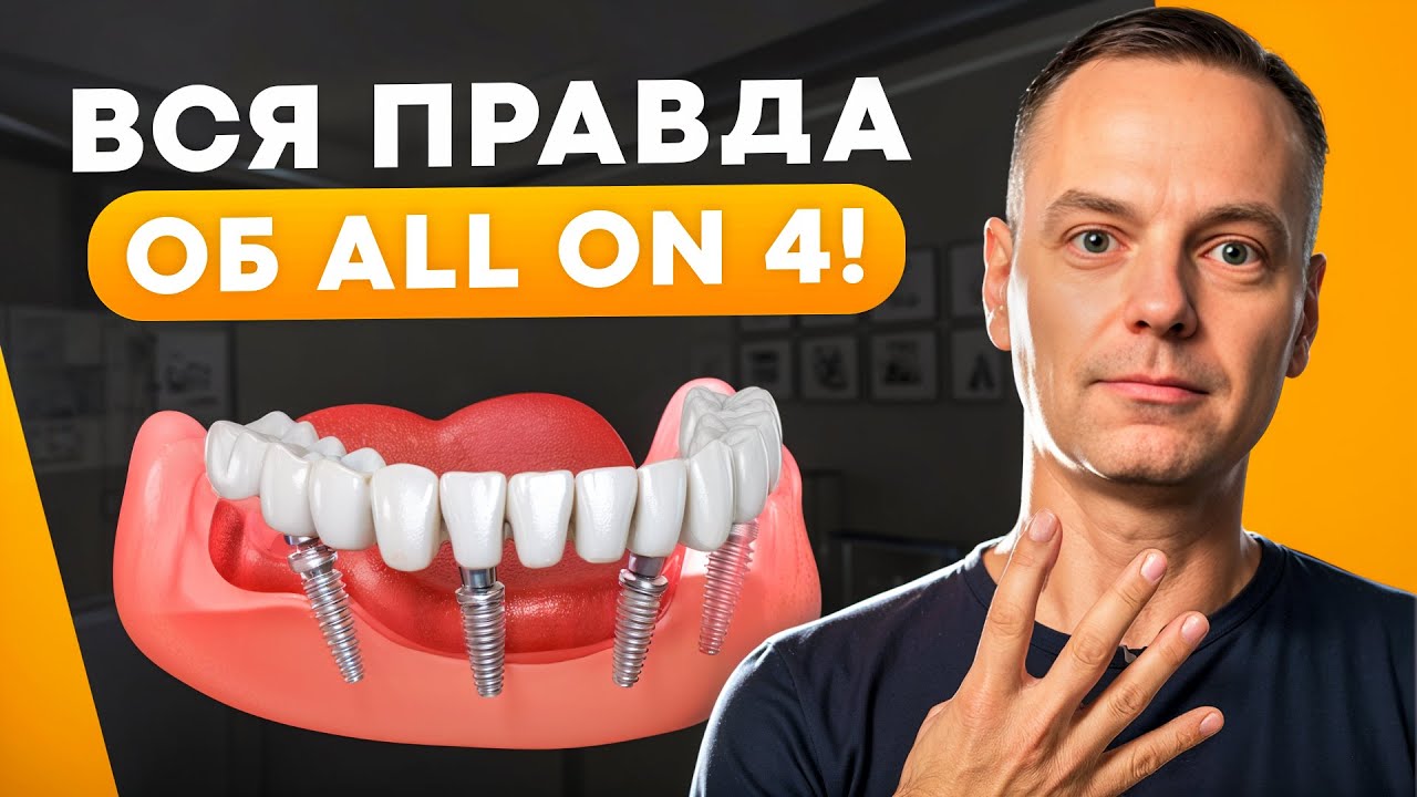 Вся правда об Имплантации All ON 4 все на четырех!