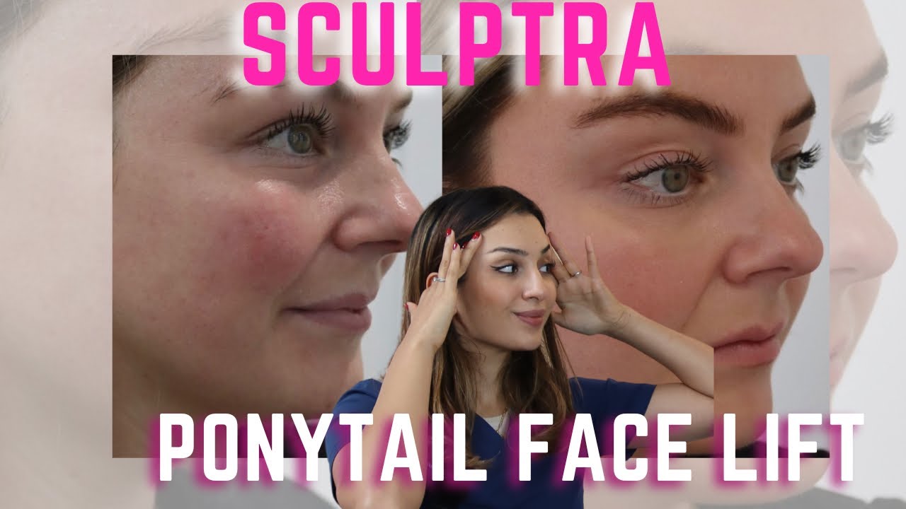 Безоперационная подтяжка лица с помощью SCULPTRA | Fox Eye и эффект SNATCHED