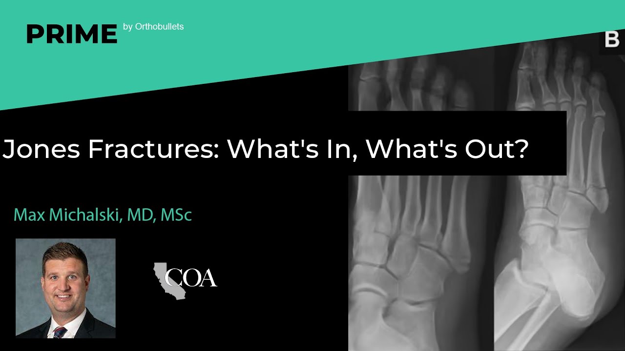 Jones Fractures: What's In, What's Out? - Max Michalski, MD, MSc