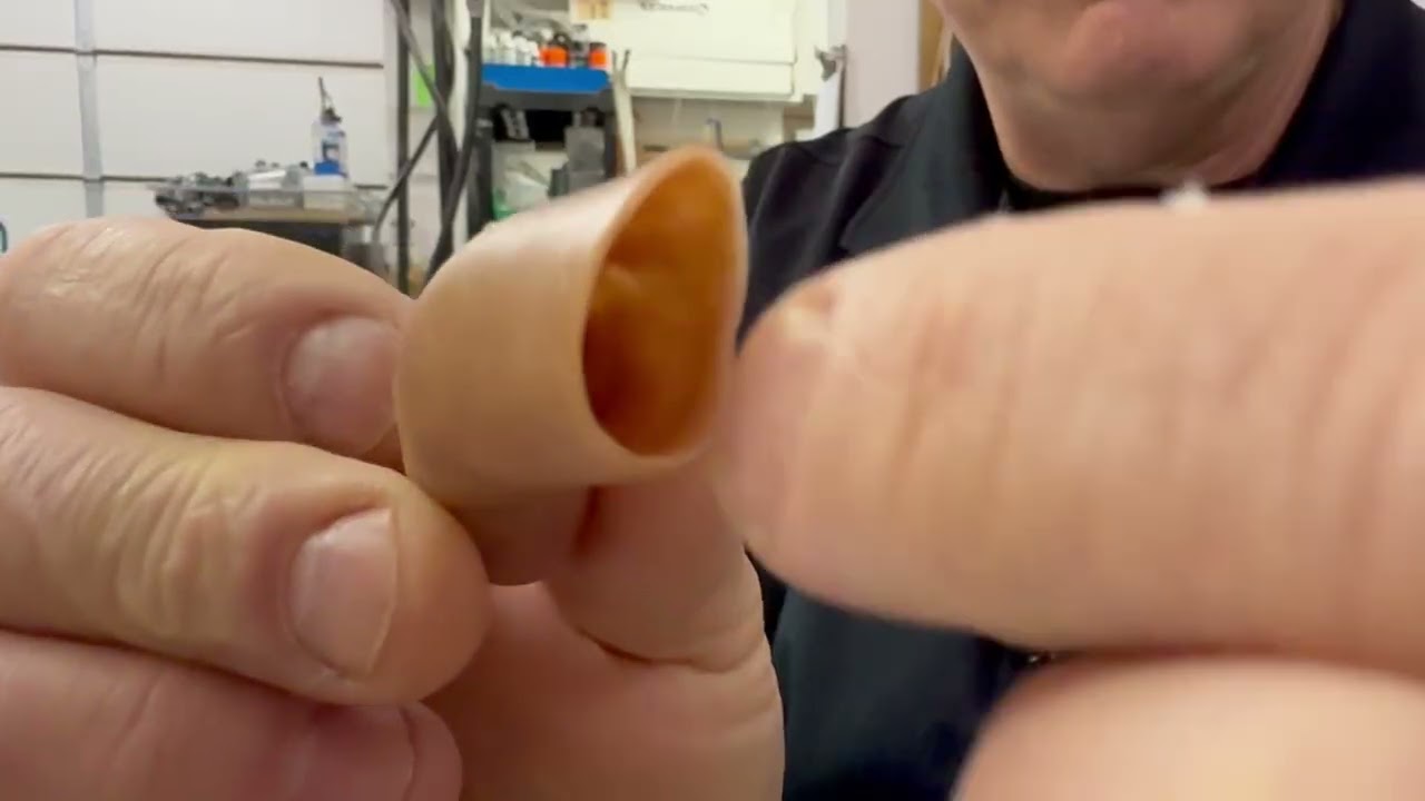 Real Life Prosthetics: Alloplastic Fifth Digit Prosthesis 6-month Follow-up Appointment