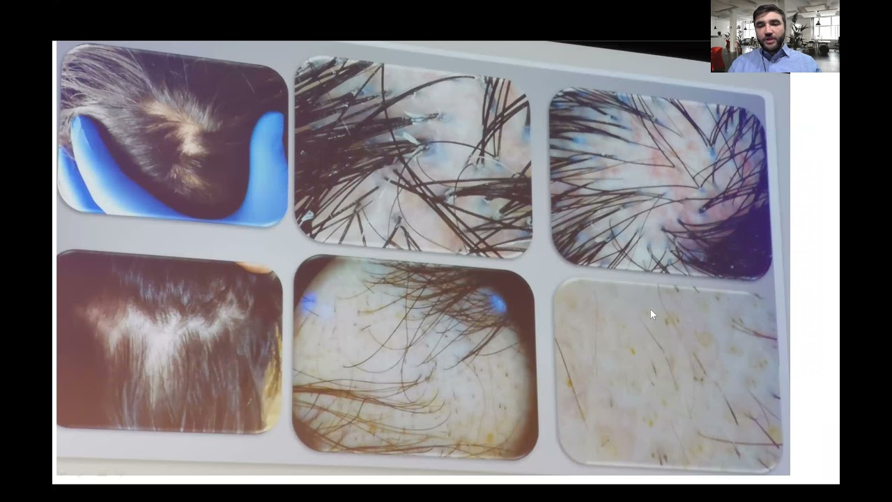 Top Hair Presentations American Academy of Dermatology Summer Meeting 2021