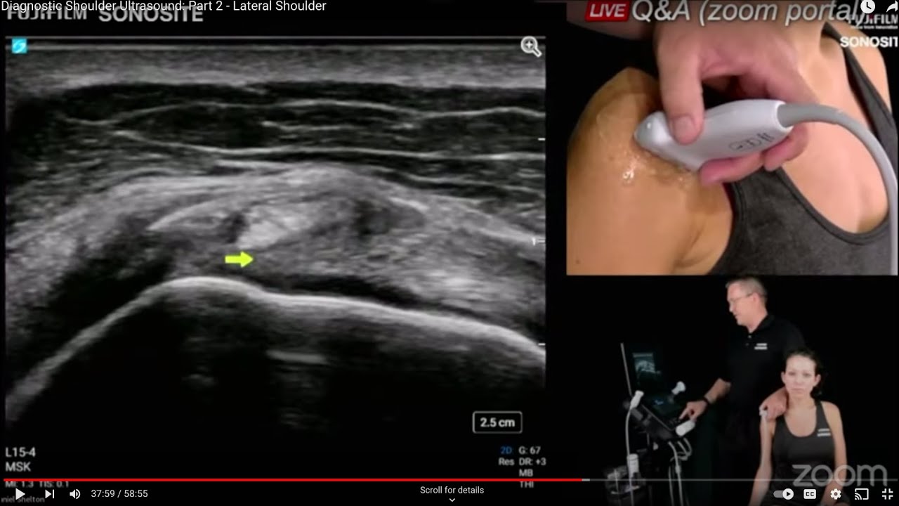 Diagnostic Shoulder Ultrasound: Part 2 - Lateral Shoulder