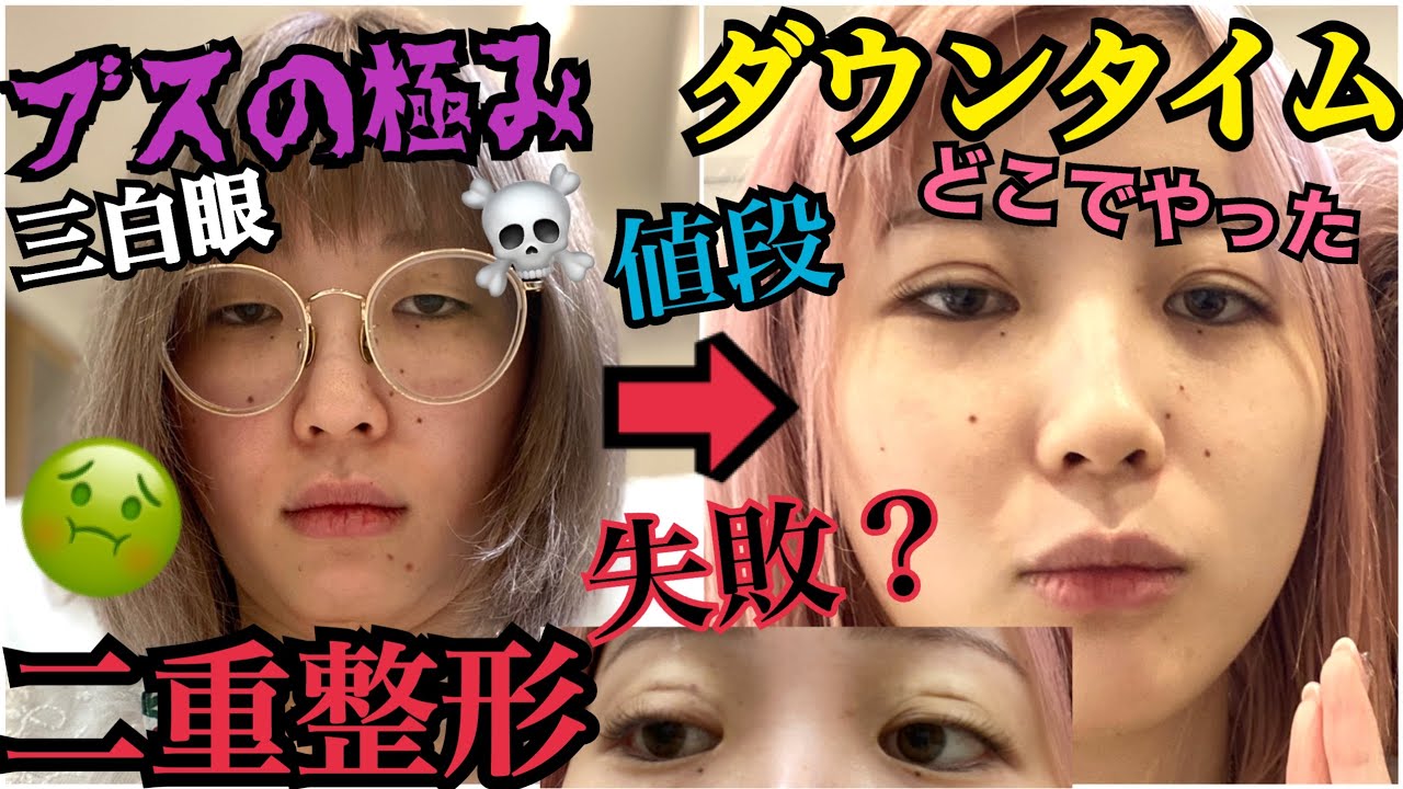 【初整形】ブスが二重整形して来ました‼︎‼︎ダウンタイムを初公開します。