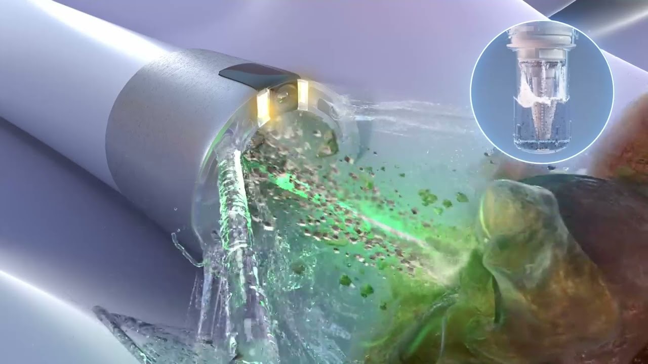 Calyxo SURE Procedure with CVAC System | Kidney Stone Removal