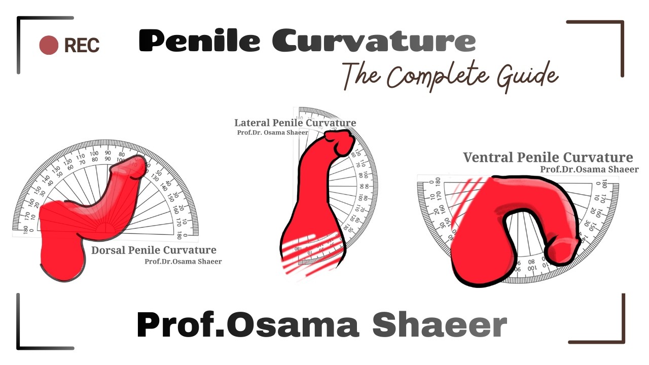 The Curved Penis: The Expert Opinion. #penile_curvature #penile_deviation #curved_penis