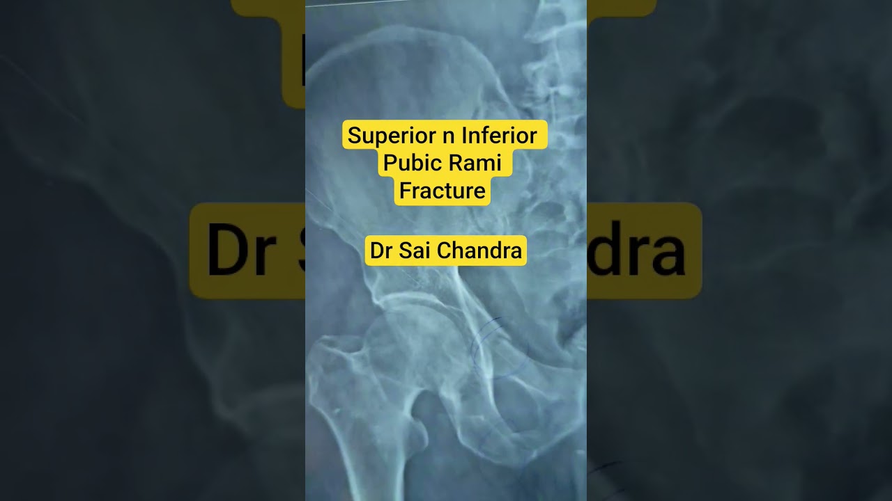 Superior n Inferior Pubic Rami Fracture.. Dr Sai Chandra MBBS DNB Ortho