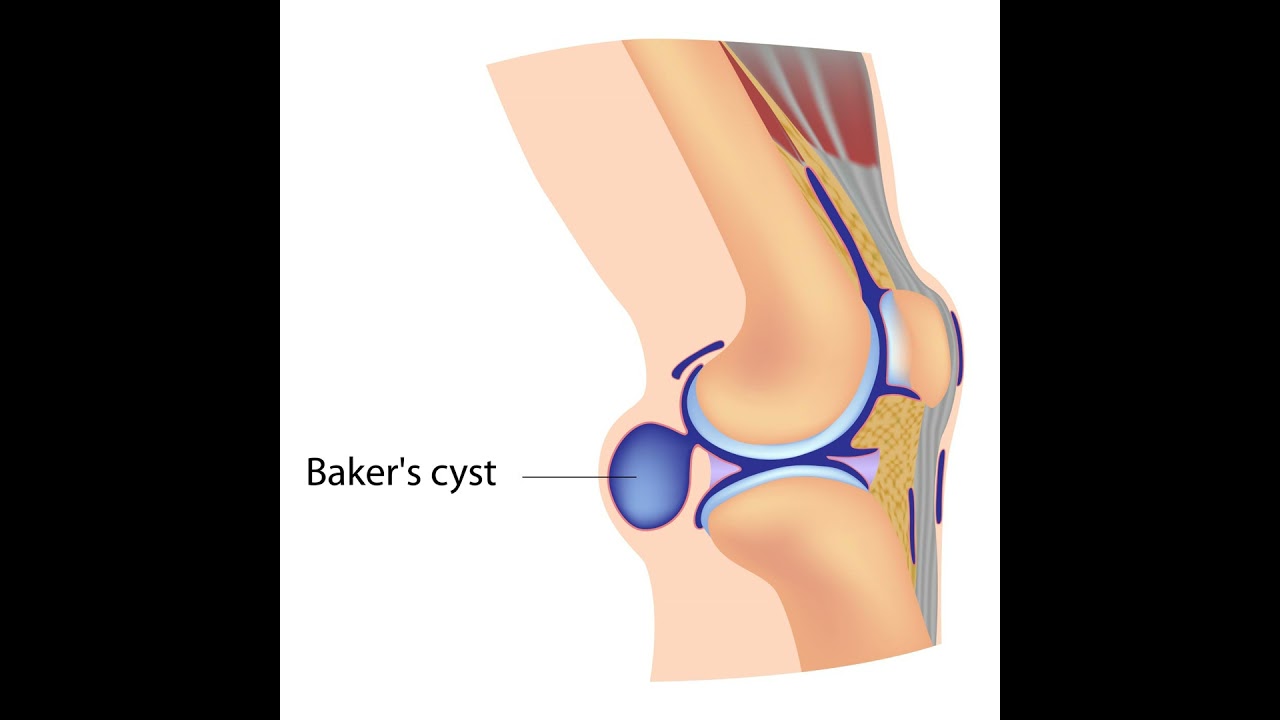 107: Knee Deep: Understanding Baker&rsquo;s Cysts (with Whitney Lowe & Til Luchau)