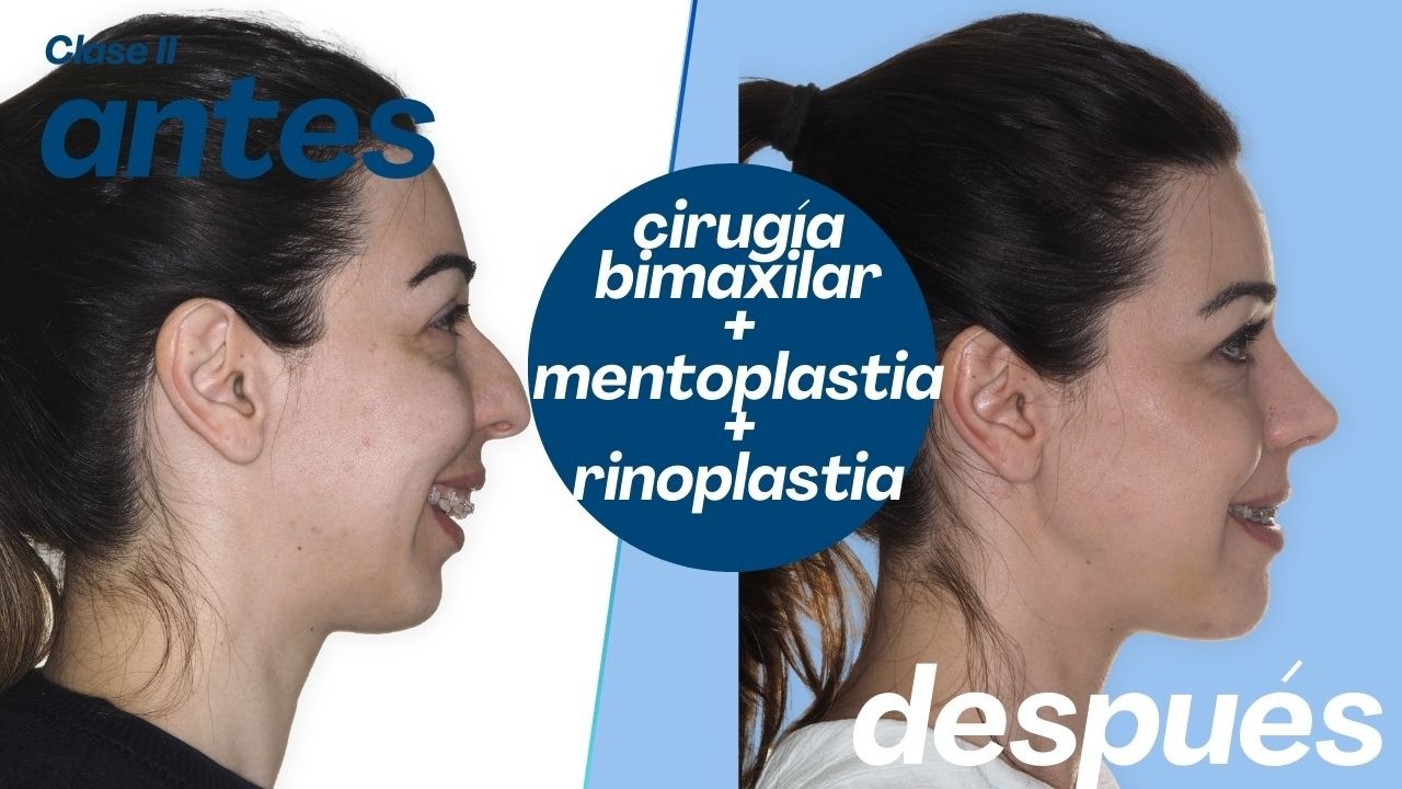 Cirug&iacute;a bimaxilar Caso #163: Brittany- Clase II, Retrusi&oacute;n maxilo-mandibular, Api&ntilde;amiento dental