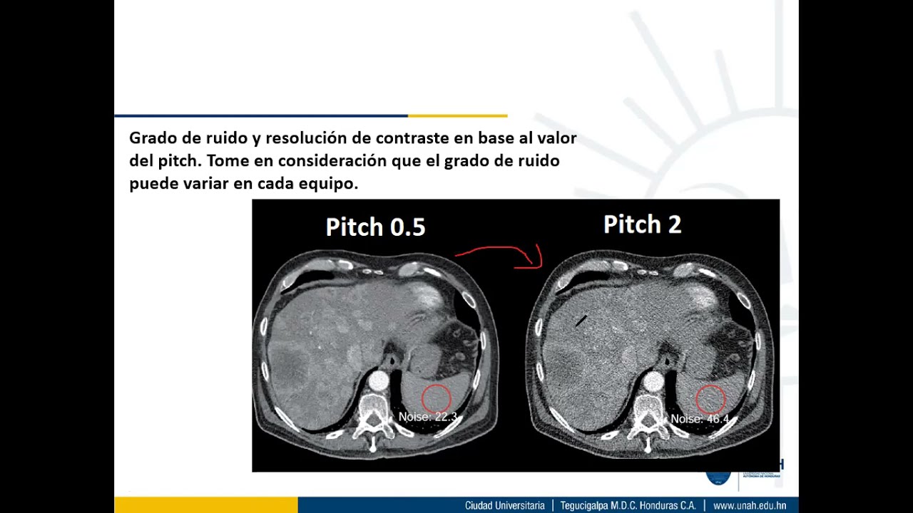 Intro Imagenologìa 1400 y 1800: Pitch y tiempo de analisis en tomografía