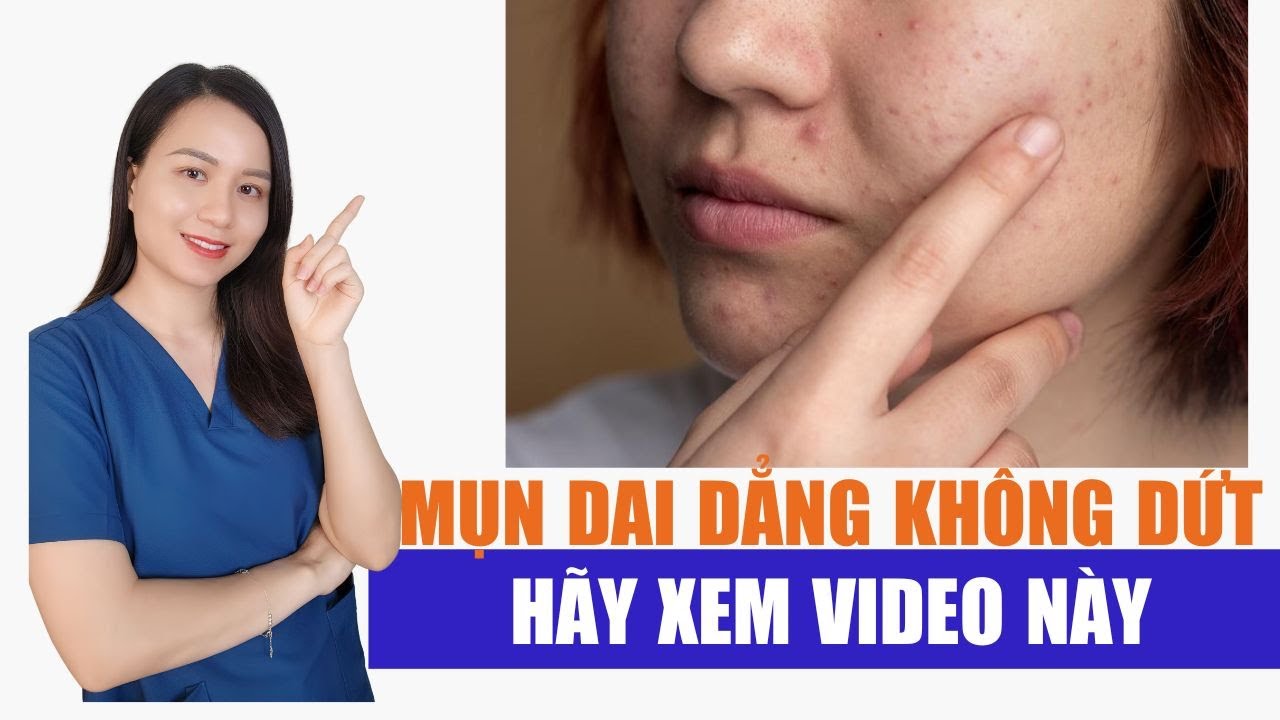 Nếu bạn bị mụn dai dẳng không dứt hãy xem video này !| Nguyễn Mai Hương