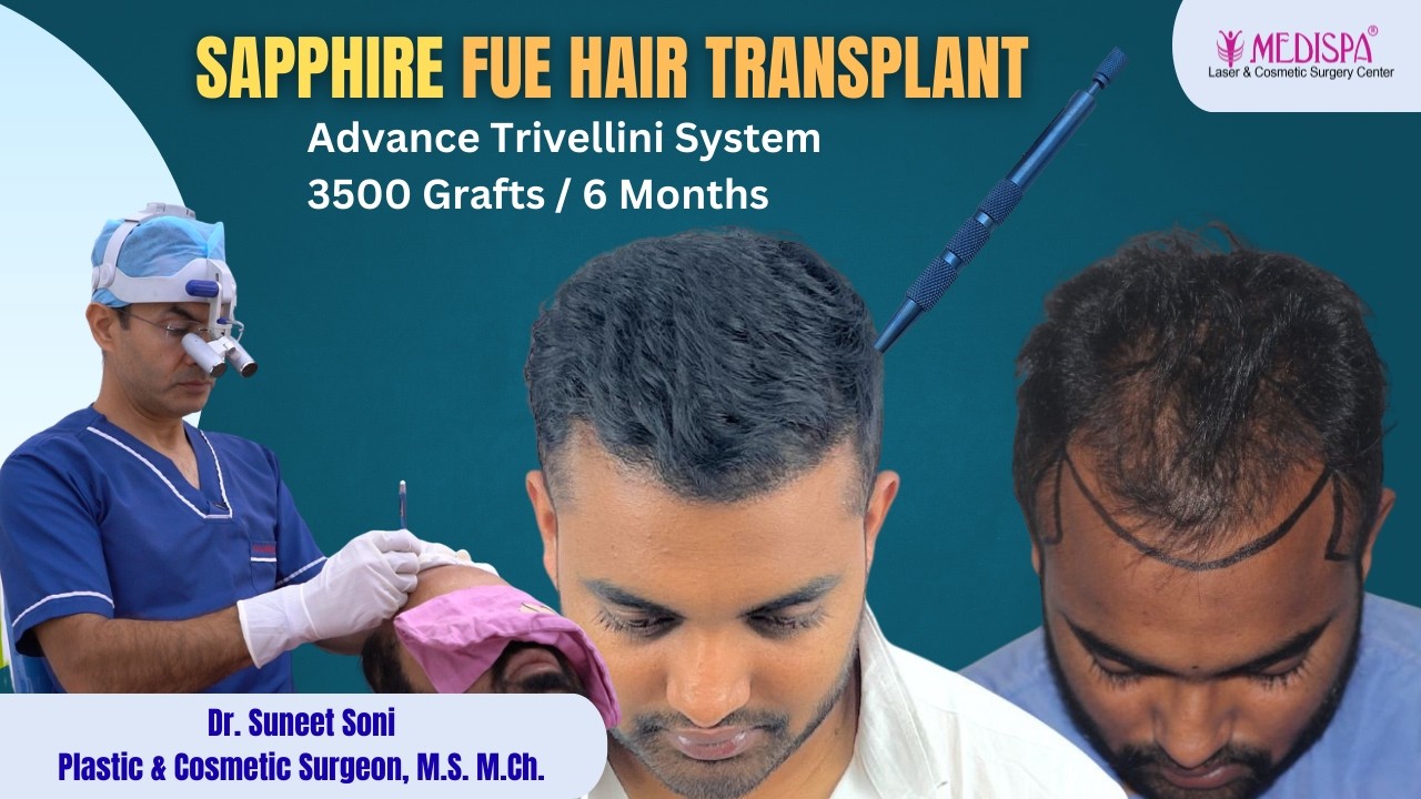 6 Months After 3500 Grafts Hair Transplant | Advanced Sapphire & Trivellini Results by Dr Suneet