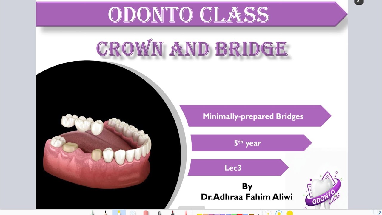 Crown and bridge.5.lec3.Minimally Prepared Bridge 