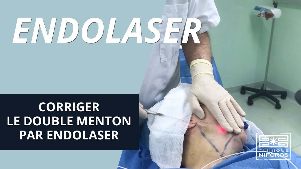 Traitement du double menton par endolaser associé à une liposuccion