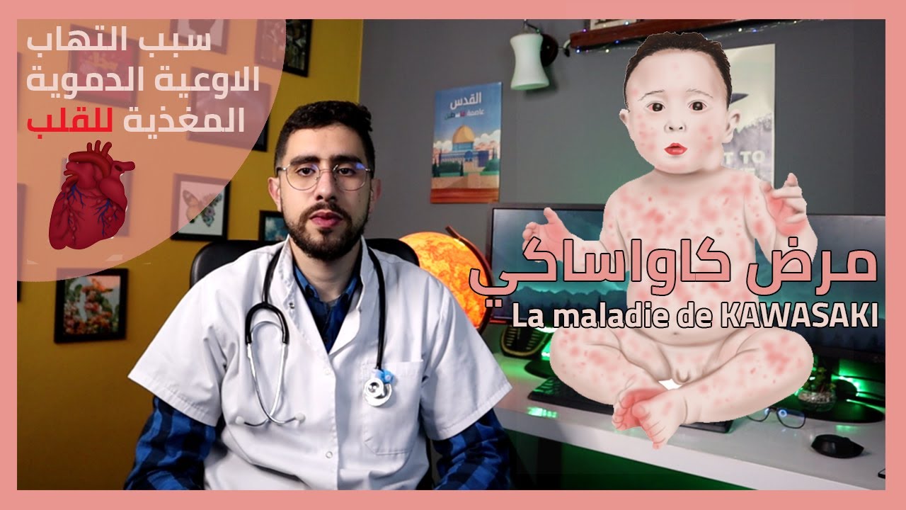مرض كاواساكي وخطورته عند الاطفال  Maladie de Kawasaki