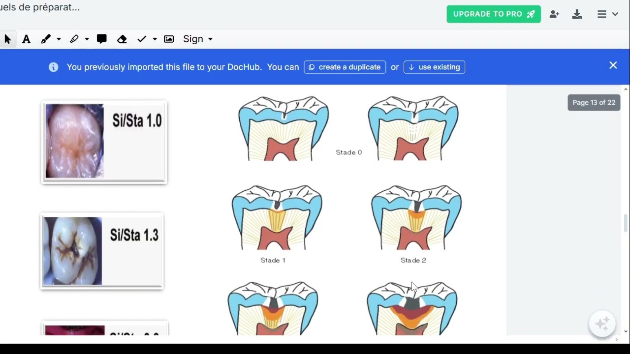 OCE  : Concepts actuels de préparation de cavités en dentisterie adhesive