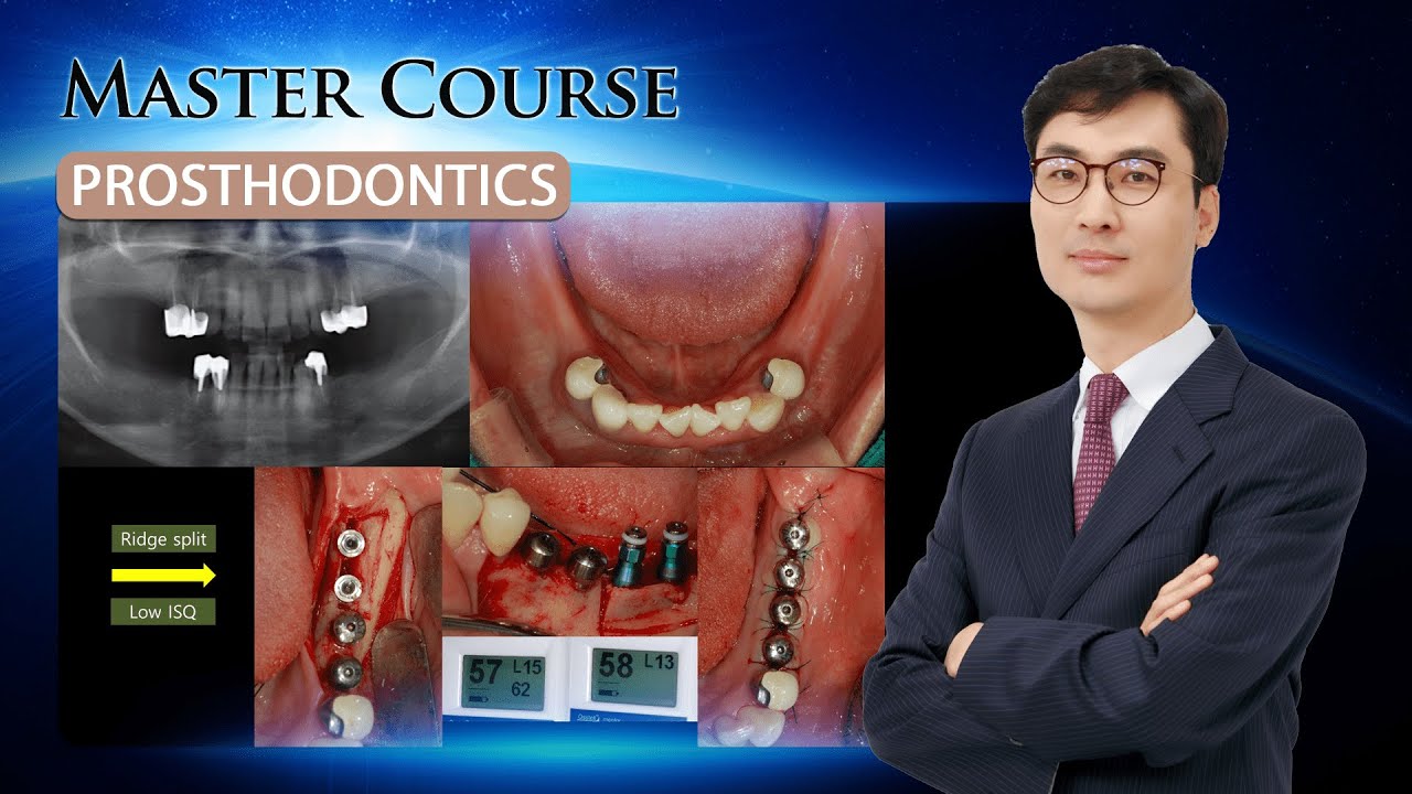 [Master Course - PROSTHODONTICS] Loading protocol of implant prosthesis