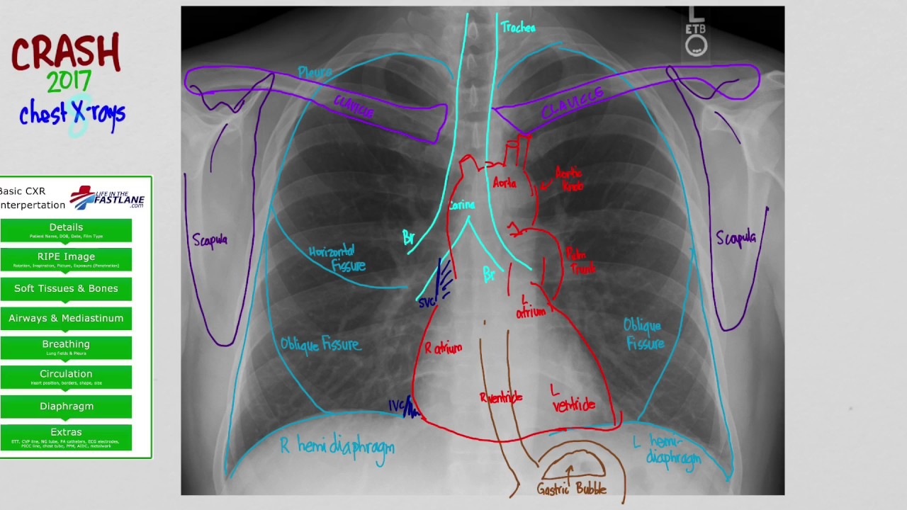 01 CXR Anatomy