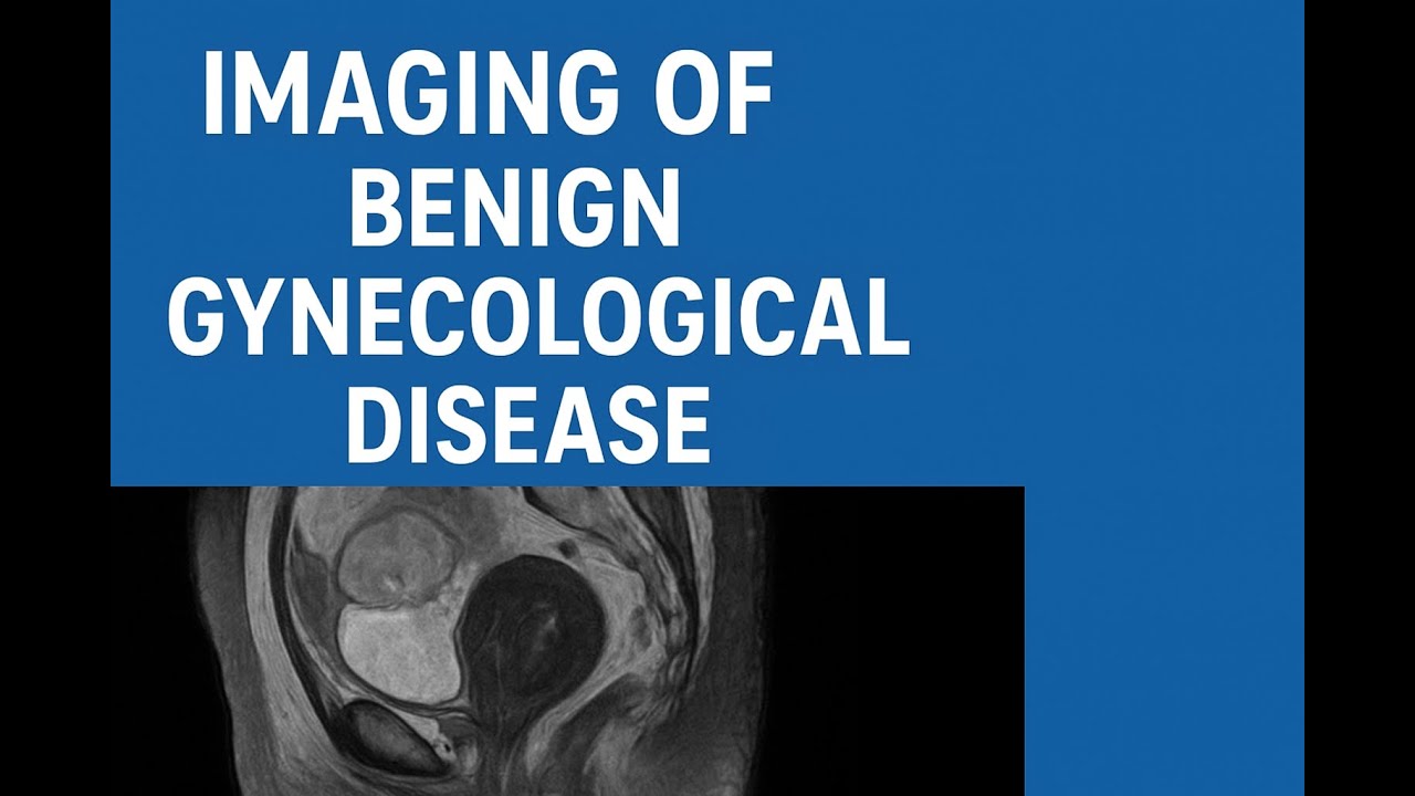 Imaging of Benign Gynecological Diseases