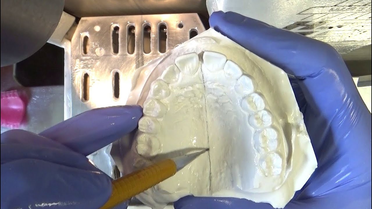 KFO Diagnostik-Modelle trimmen. Orthodontic Study Models Trimming