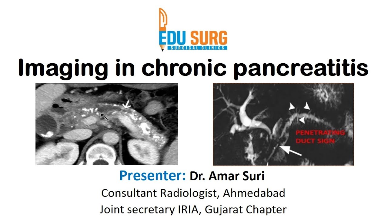 Radiology masterclass on Chronic pancreatitis - Role of CT, MRCP and recent advances - Dr. Amar Suri