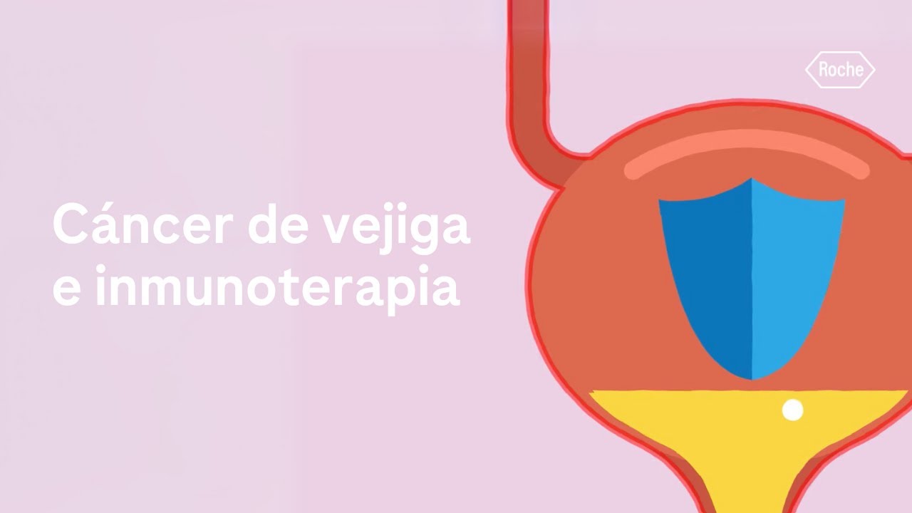Cáncer de vejiga: ¿cómo funciona la inmunoterapia y qué la diferencia de otros tratamientos?