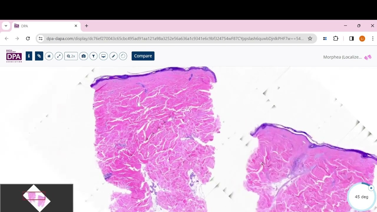 Morphea