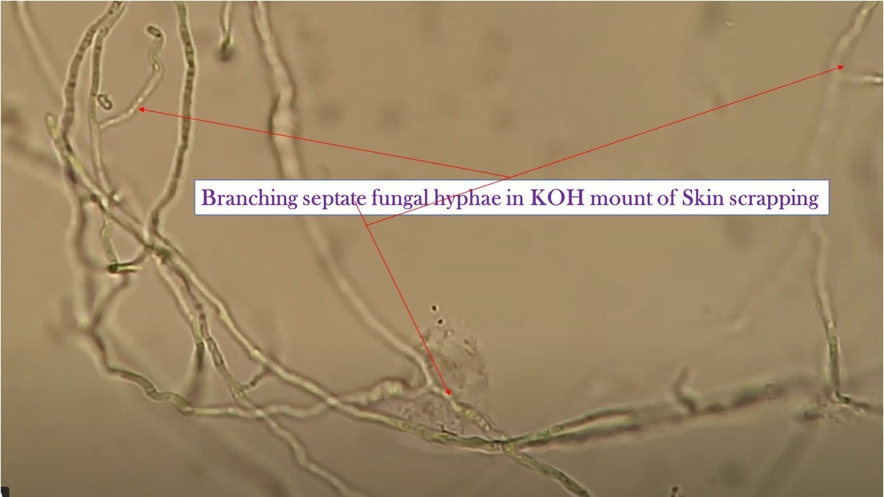 Branching Septate Fungal Hyphae in KOH Mount of Skin Scrapping at various magnifications