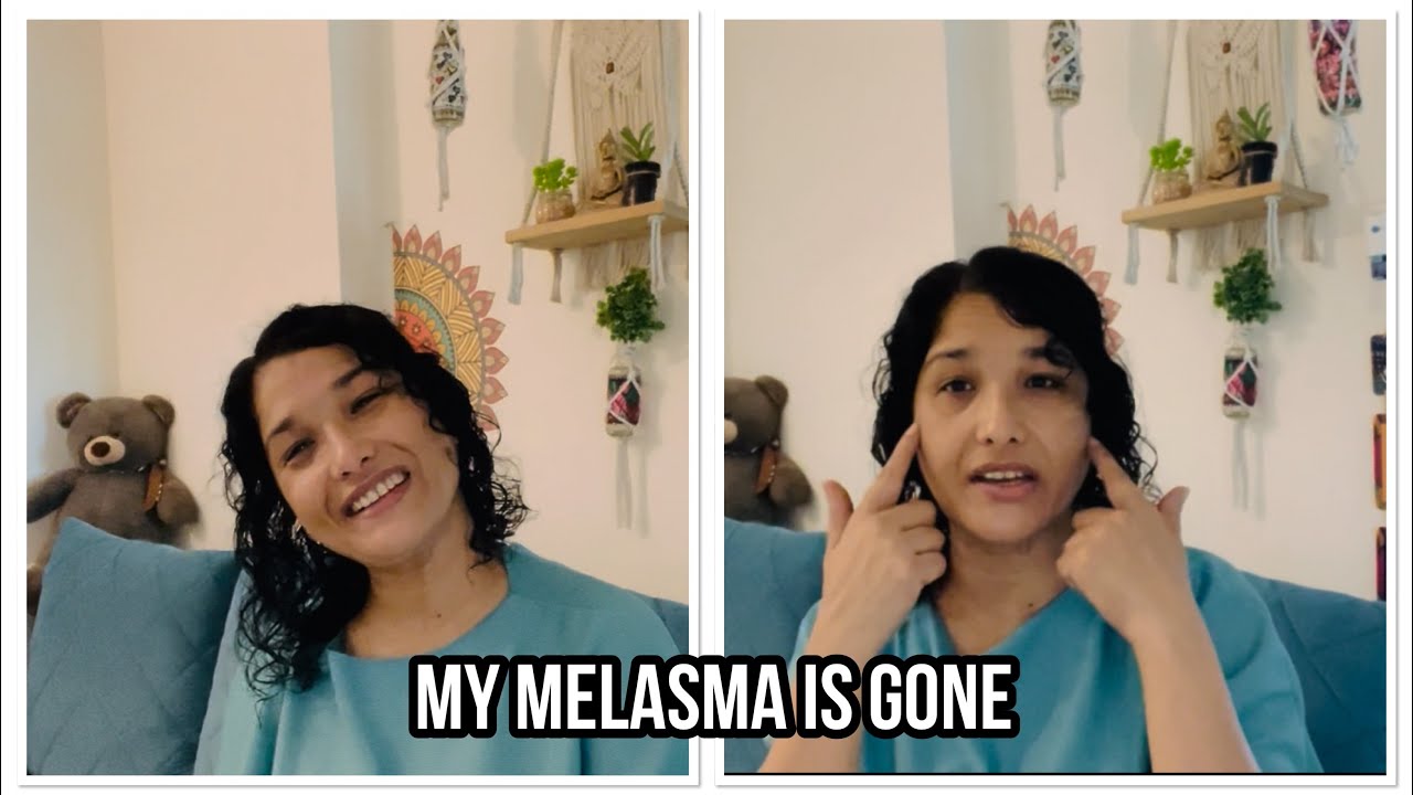 My melasma is gone naturally #melasma #pigmentation #selfcare 