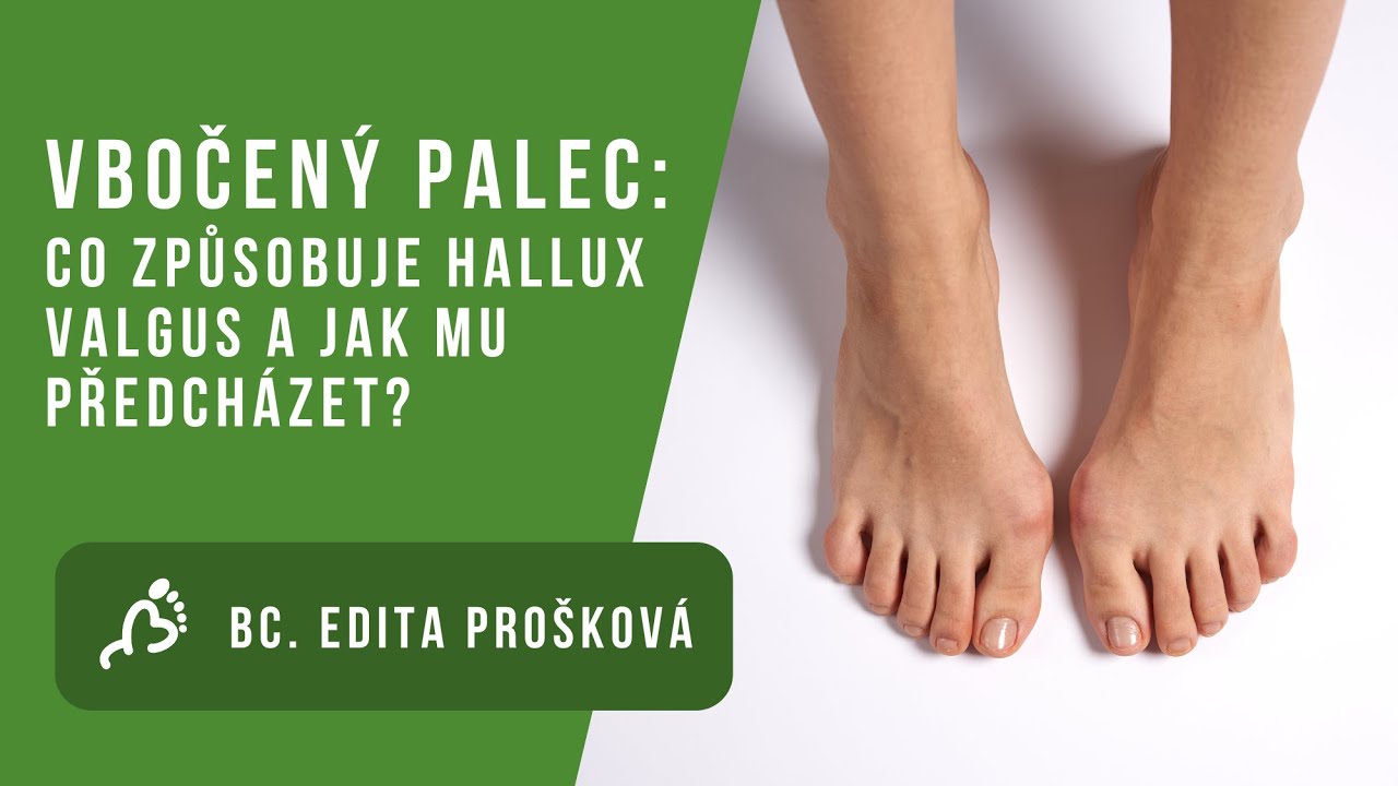 Bc. Edita Prošková: Vbočený palec pod lupou: Co způsobuje hallux valgus a jak mu předcházet?