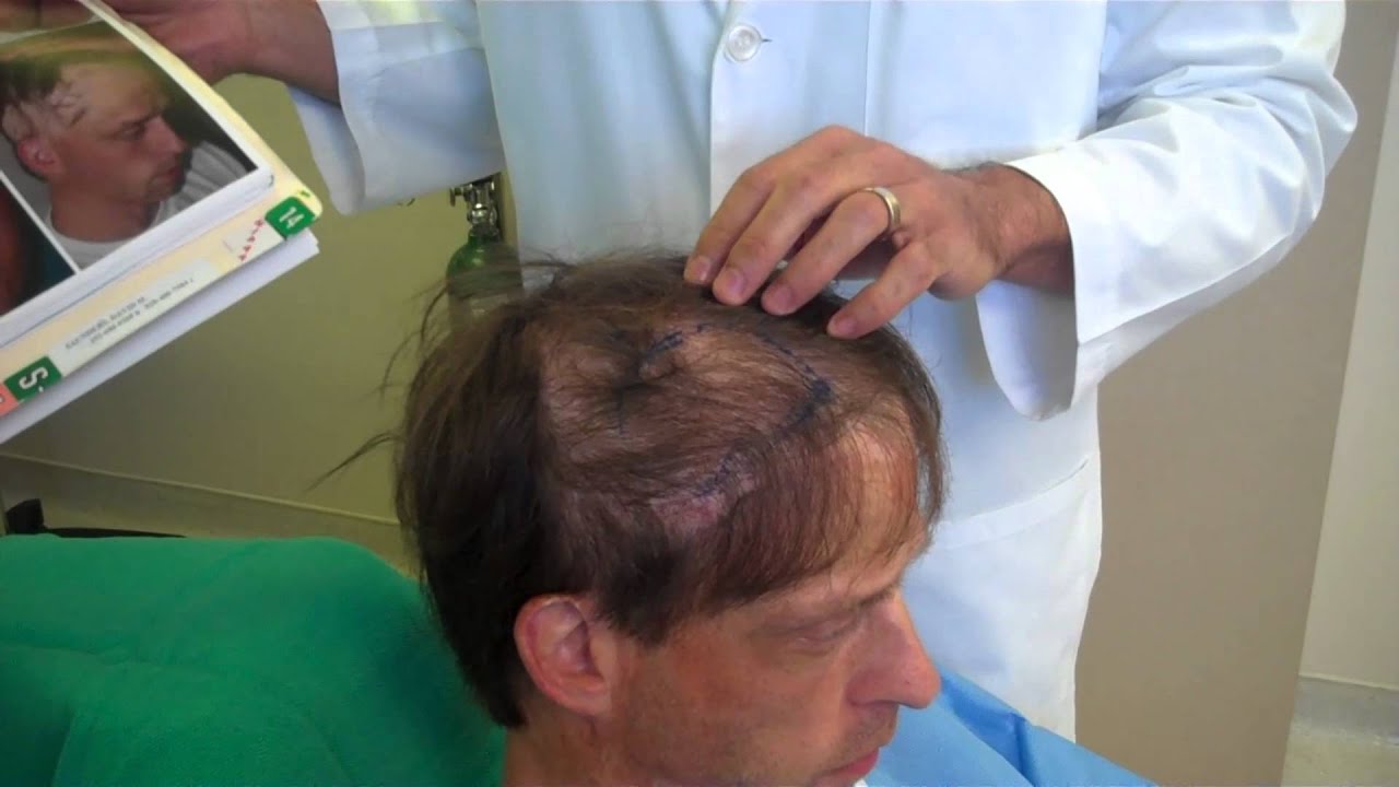 Hair Restoration for Burn Scar: Patient Transformation Revealed | Anthony Bared, MD, FACS Miami, FL